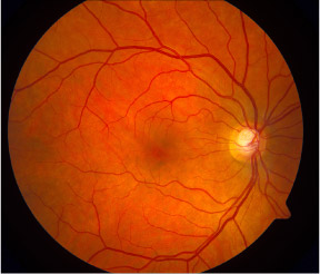 Normal Retina