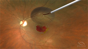 AVA-101 is injected into the eye in a short surgical procedure. Photo 1